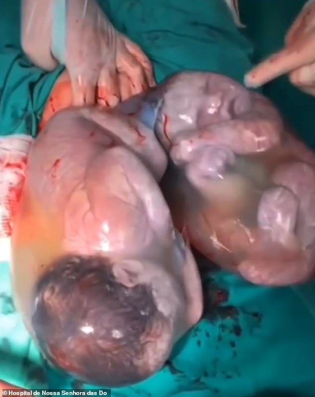 Las gemelas Maria Cecilia y Maria Alice dentro de sus bolsas amnióticas después de que los cirujanos brasileños las sacaran del útero de su madre el 11 de junio.